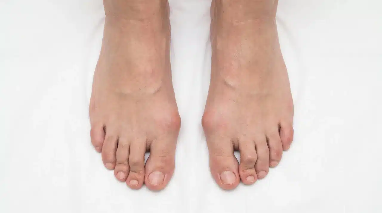 Top-down view of two feet showing bunion deformity and hammertoe with toe misalignment on a clean white clinical background.