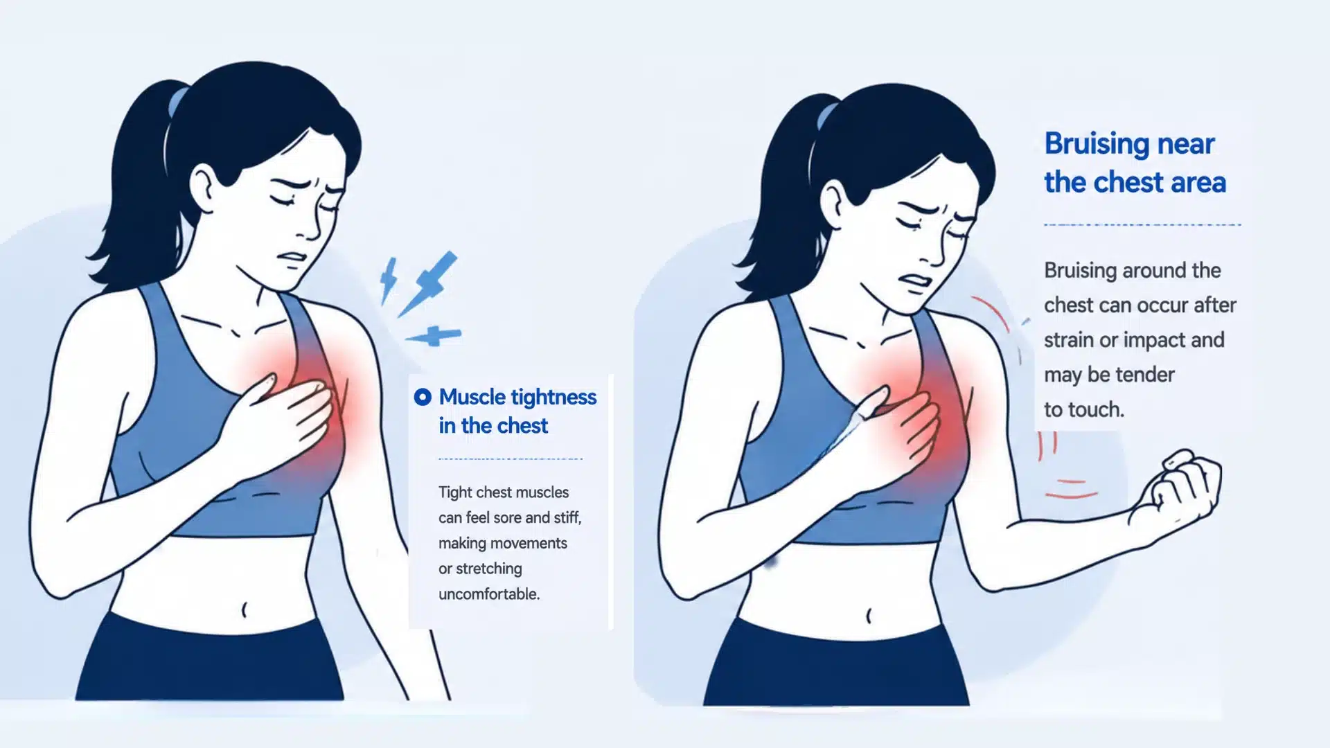 Medical illustration showing swelling or bruising around the chest wall caused by a chest muscle strain or injury.